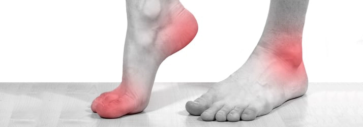 Chiropractic Vancouver WA Plantar Fasciitis